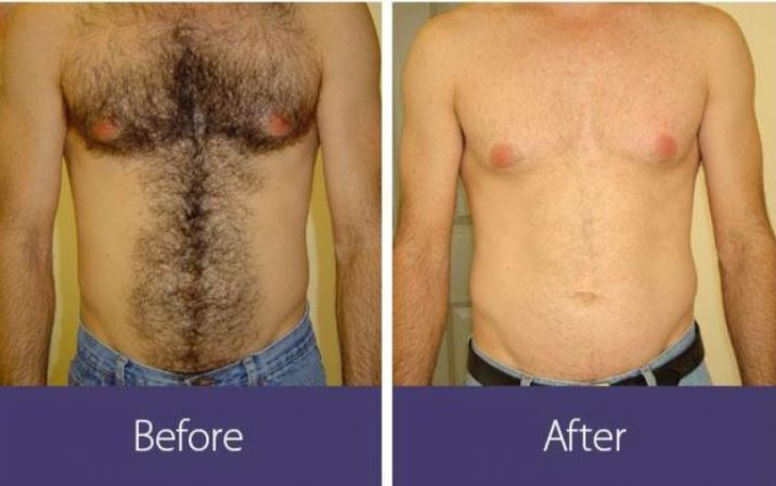 How Long Does Laser Hair Removal Last Boston Laser Hair Removal