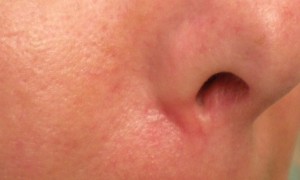 Basal Cell Carcinoma Treatment Wellesley, Ma