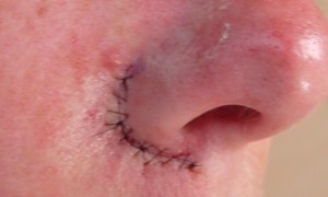 Basal Cell Carcinoma Treatment Wellesley, MA