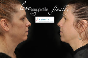 Kybella Before & After Wellesley, Ma