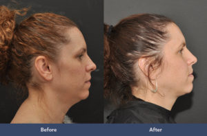 Kybella Before & After Wellesley, Ma