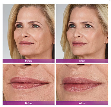 Juvederm before and after Krauss Dermatology Wellesley