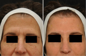 Botox Before & After Wellesley, Ma