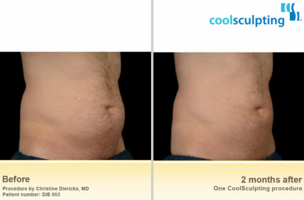 CoolSculpting Before & After Wellesley, MA Krauss Dermatology