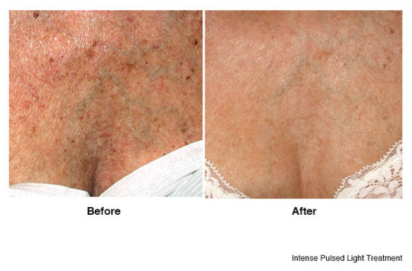 IPL Treatment Before & After Krauss Dermatology