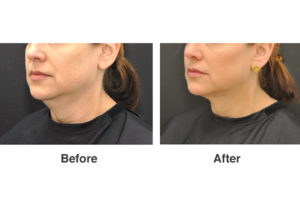 Ultherapy Before & After Wellesley, Ma