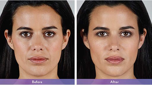 Juvederm Before & After Wellesley, MA