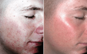 2021 dating treatment scars best ☝️ with acne Best Acne