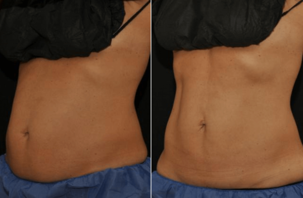 Body CoolSculpting® Before After Boston