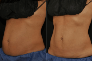 Coolsculpting Results Before & After Wellesley, Ma