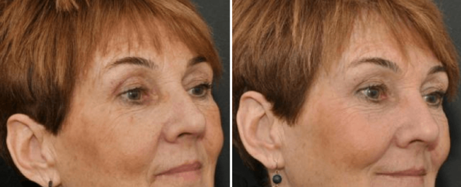 Juvederm Results Wellesley, MA