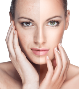 Skin Texture Treatments Wellesley, MA