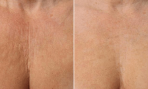 Wrinkle Treatment Before & After Wellesley, MA