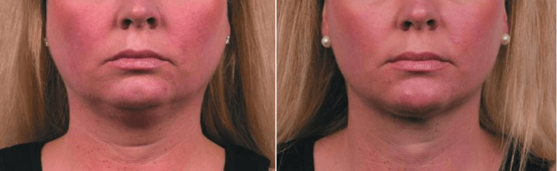 Facial Coolsculpting® Before After Krauss Boston