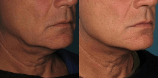 Facial Ultherapy Before After Gallery Krauss Dermatology(1)