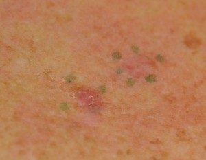 Basal Cell Carcinoma Wellesley