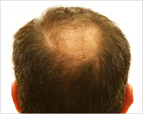 Hair Loss Treatment Wellesley, MA