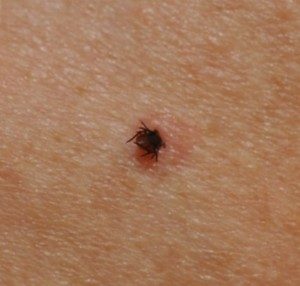 Lyme Disease Tick Bite Boston