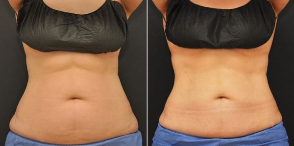 How Much Does CoolSculpting Cost in Boston