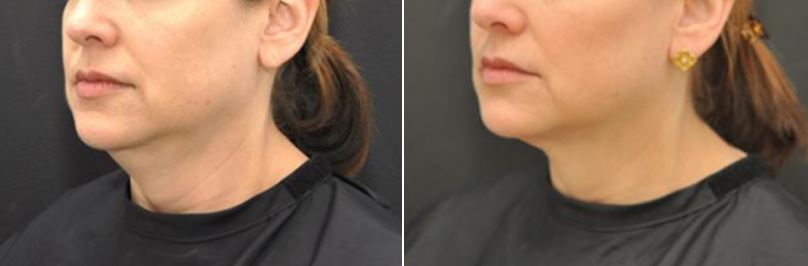 does coolsculpting work on double chin reddit