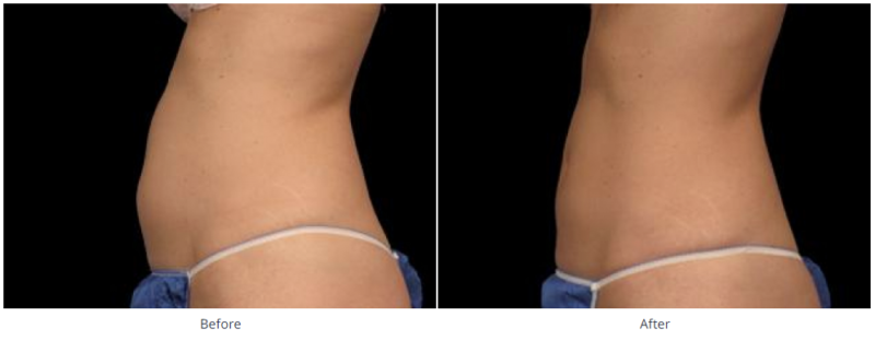 CoolSculpting Elite® Boston  Non-Surgical Fat Reduction Wellesley